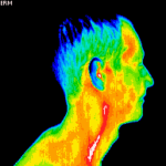 carotid